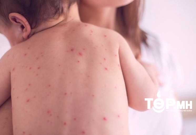 Улаанбурхан өвчний 8 тохиолдол батлагдлаа