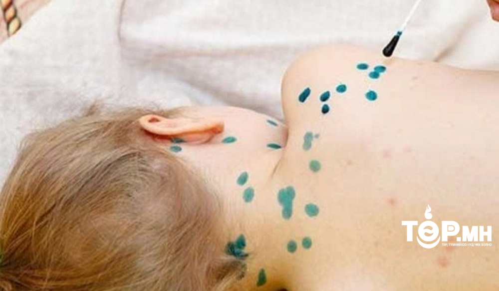 Бага насны хүүхдүүдийн дунд салхин цэцэг өвчний дэгдэлт өндөр байна