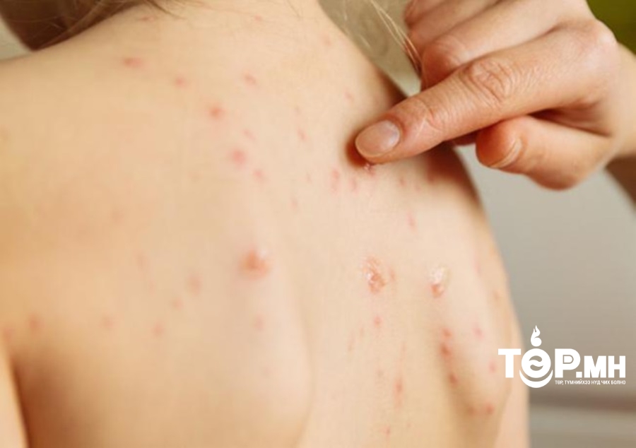 Улаанбурханы 15 шинэ тохиолдол бүртгэгджээ